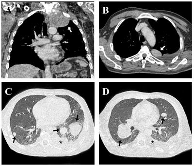 Malignant lung PEComa (clear cell tumor): rare case report and literature review